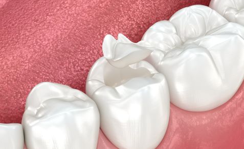 CEREC-inlays-onlays-pukekohe