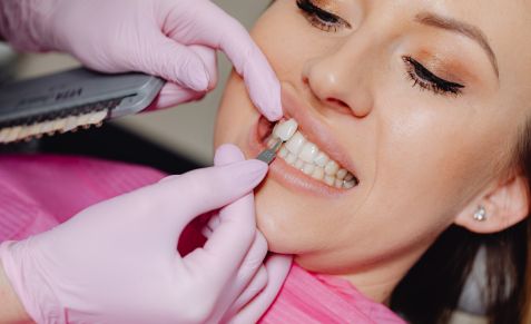 CEREC-veneers-pukekohe