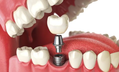 dental-implants-pukekohe